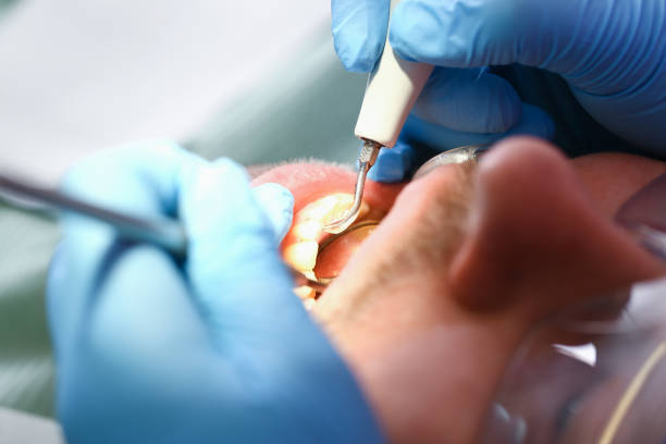 Best Emergency Tooth Extraction in Rockport, IN