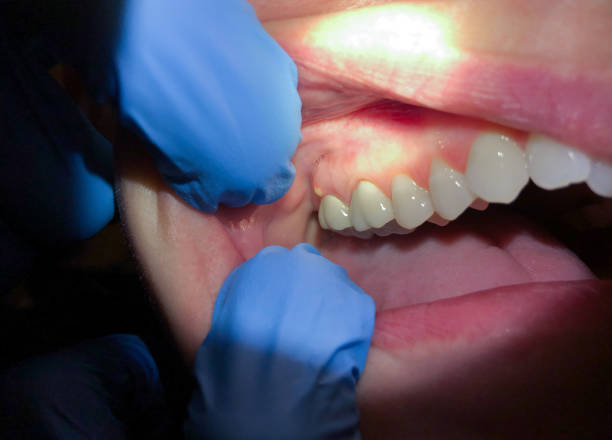 Best Emergency Tooth Extraction in Rockport, IN