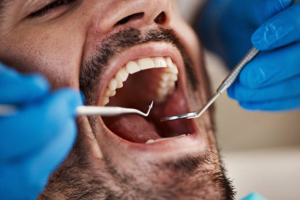 Best Emergency Wisdom Teeth Removal in Rockport, IN